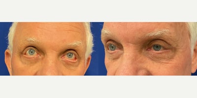 Eyelid Surgery before and after photo