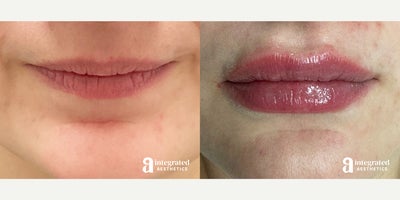 Lip Fillers before and after photo