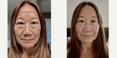 Eyelid Surgery before and after photo