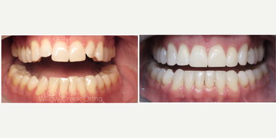 Invisalign before and after photo