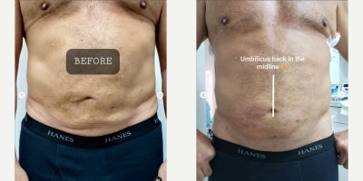 Liposuction Revision before and after photo
