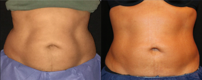 Smart Lipo before and after photo