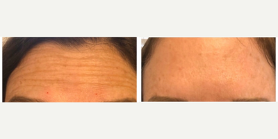 Botox before and after photo
