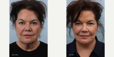 Deep Plane Facelift before and after photo
