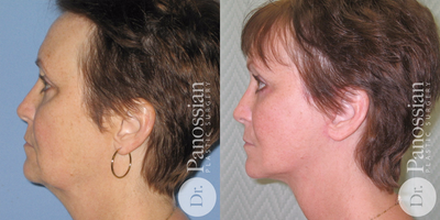 Facelift before and after photo