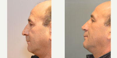 Rhinoplasty before and after photo