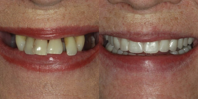 All-on-4 Dental Implants before and after photo