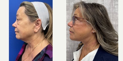 before and after image
