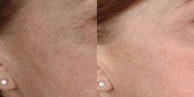 Derma Roller before and after photo