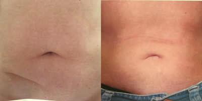 Liposuction before and after photo