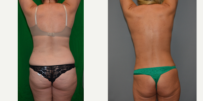 Liposuction before and after photo