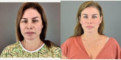 Neck Lift before and after photo