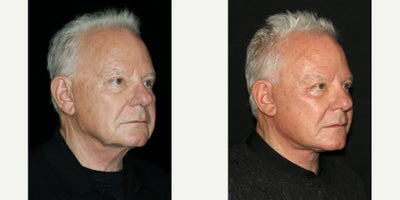 Neck Lift before and after photo