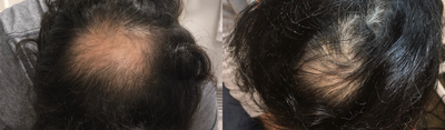 PRP for Hair Loss before and after photo