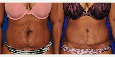 Tummy Tuck before and after photo