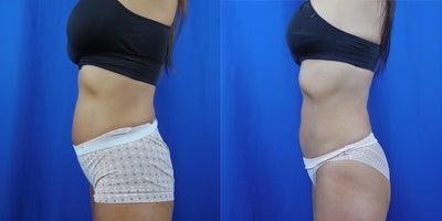 Abdominal Etching before and after photo