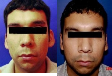 Ear Surgery before and after photo