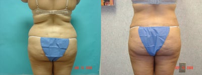 Liposuction before and after photo