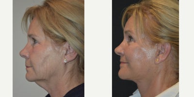 Neck Lift before and after photo