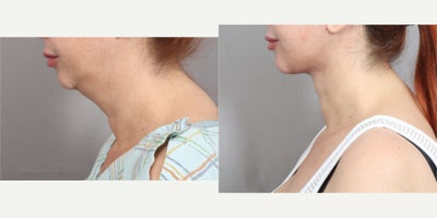 Neck Lift before and after photo