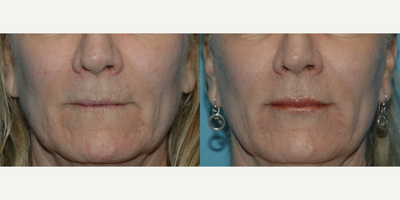 Restylane before and after photo