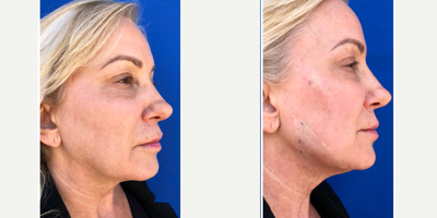 Skin Tightening before and after photo