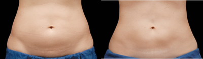 CoolSculpting before and after photo