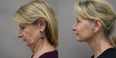 Deep Plane Facelift before and after photo