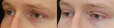 Eyelid Surgery before and after photo