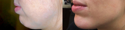 Chin Filler before and after photo