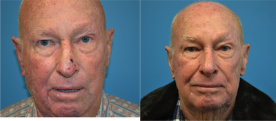 Facial Reconstructive Surgery before and after photo