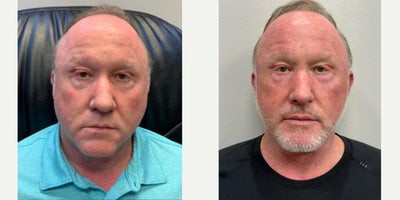 Liposuction before and after photo