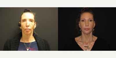 Liquid Facelift before and after photo