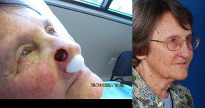 Mohs Surgery before and after photo