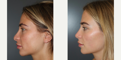Revision Rhinoplasty before and after photo