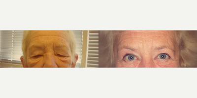 Brow Lift before and after photo