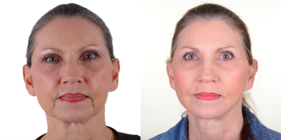 Facelift before and after photo