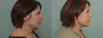 Facelift before and after photo