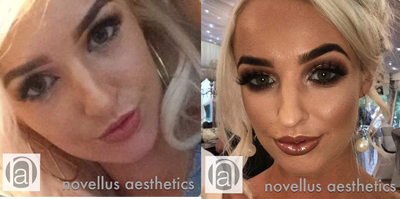 Lip Fillers before and after photo