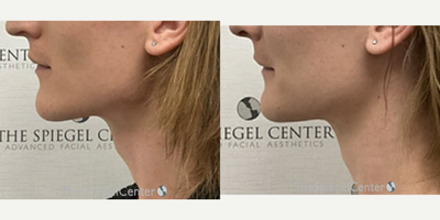 Adam's Apple Reduction before and after photo