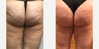 Cellfina before and after photo