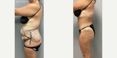 Laser Liposuction before and after photo