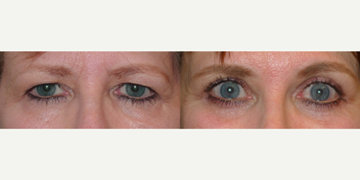 Ptosis Surgery before and after photo