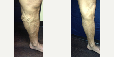Sclerotherapy before and after photo
