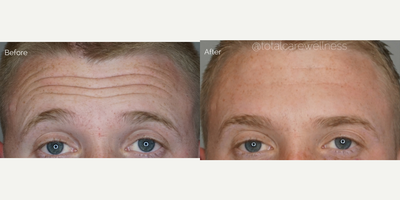 Botox before and after photo