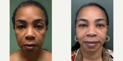 before and after image
