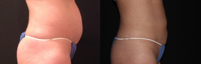 CoolSculpting before and after photo