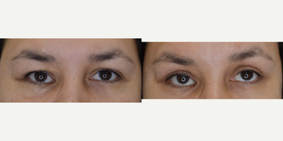 Eyelid Surgery before and after photo