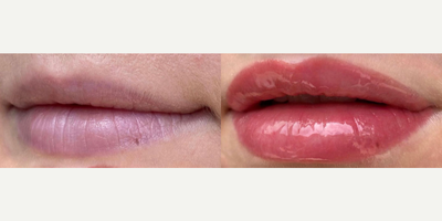 Lip Blushing before and after photo
