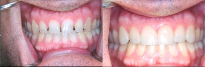Porcelain Veneers before and after photo